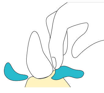Illustration of tartar removal