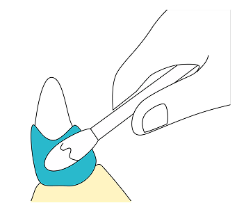 歯石に浸透させるイラスト